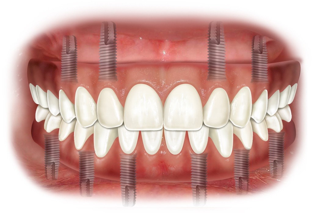 02_edentulia_post_imp Problemi di denti mancanti