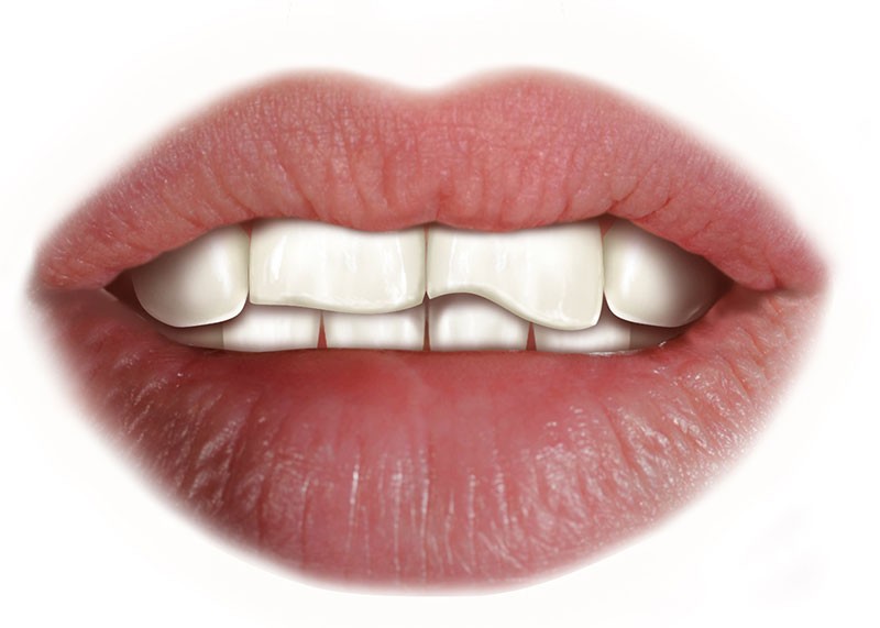 Denti consumati ed erosi