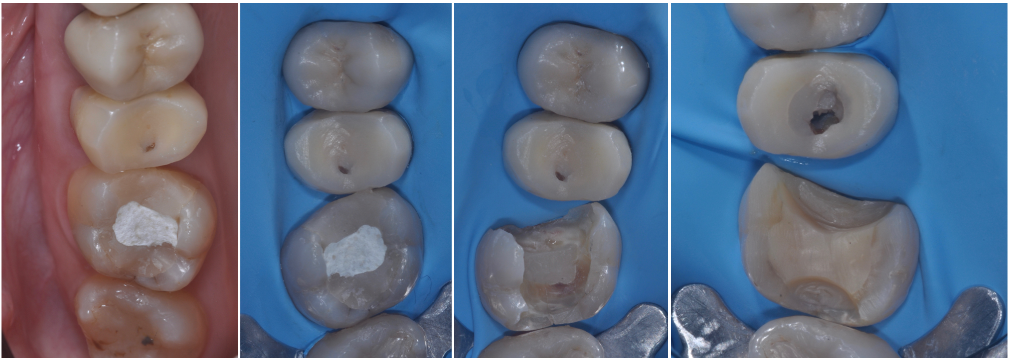 Intarsio dentale, Impronta