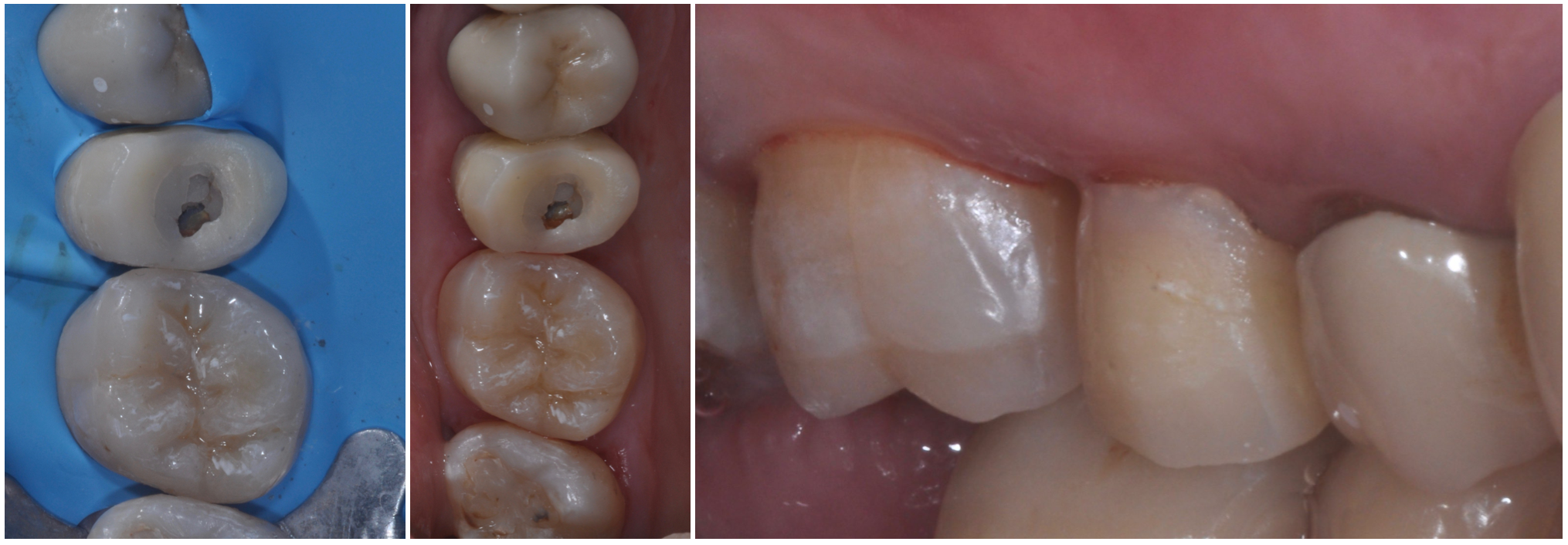 Intarsio Dentale, Diga