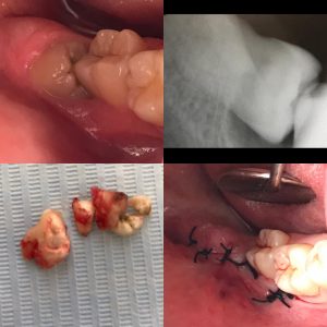 estrazione_ottavi_dente_giudizio
