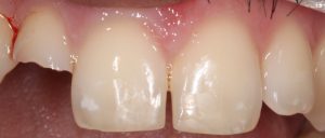 Traumi dentali_2