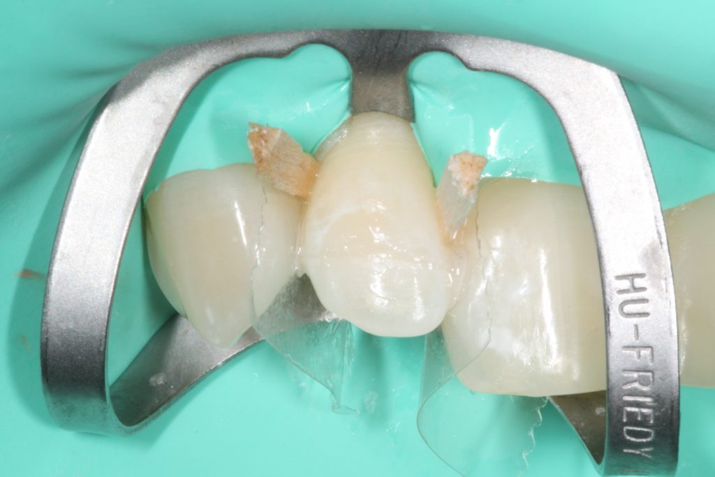 Traumi dentali_3