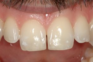 Traumi dentali_1