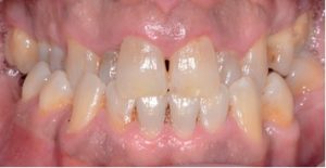 Erosione dentale