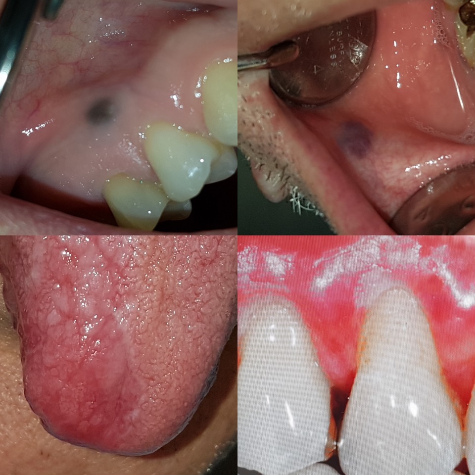 Patologia Orale_2