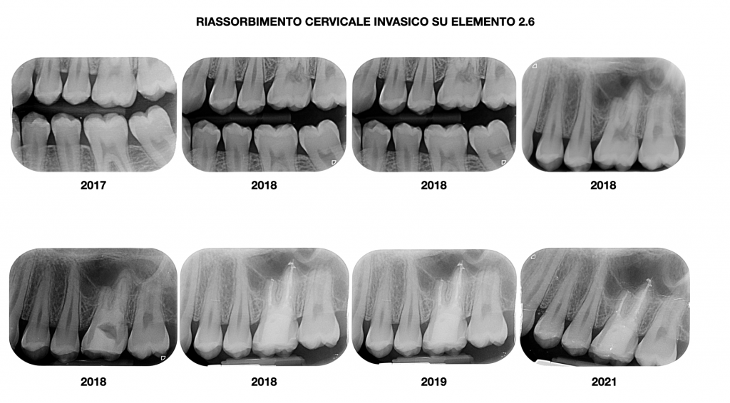 Dr D'Amico riassorbimento radicolare